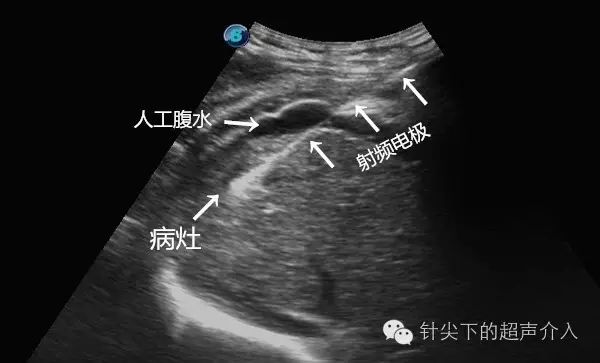 在电极两侧的距离范围随时间延长,消融强回声逐渐增大即时超声造影