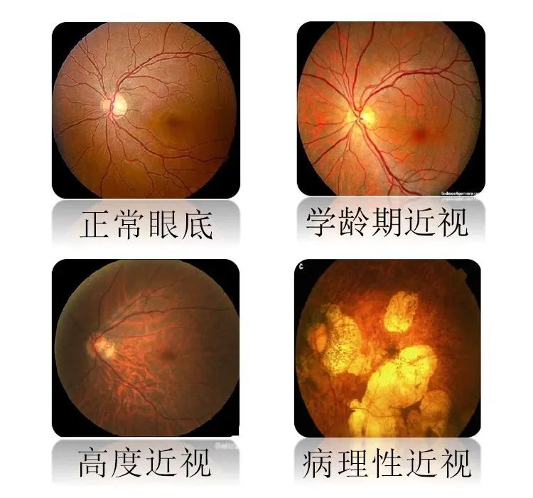 眼睛也一样,高度近视和病理性近视因为眼轴过长,后极部巩膜