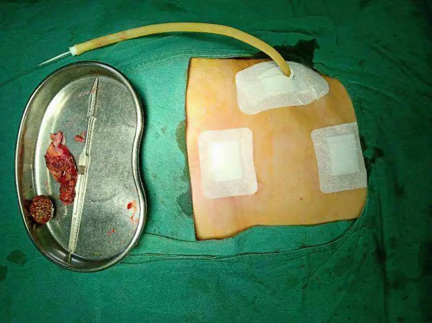 硅胶引流球怎么放置腔镜技巧 ｜ 第九期：腹腔引流管的放置指征及注意事项_https://www.jmylbn.com_新闻资讯_第5张