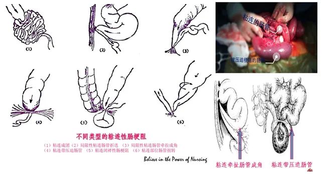 速看！一键了解术后粘连的不良影响！