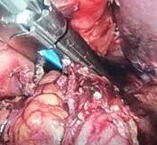 直线切割吻合器怎么用手术实践 ｜ 胃肠外科手术缝合技术（三）_https://www.jmylbn.com_新闻资讯_第3张