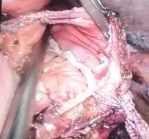 直线切割吻合器怎么用手术实践 ｜ 胃肠外科手术缝合技术（三）_https://www.jmylbn.com_新闻资讯_第2张