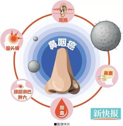 鼻塞严重以为是炎症 23岁女子确诊鼻咽癌晚期