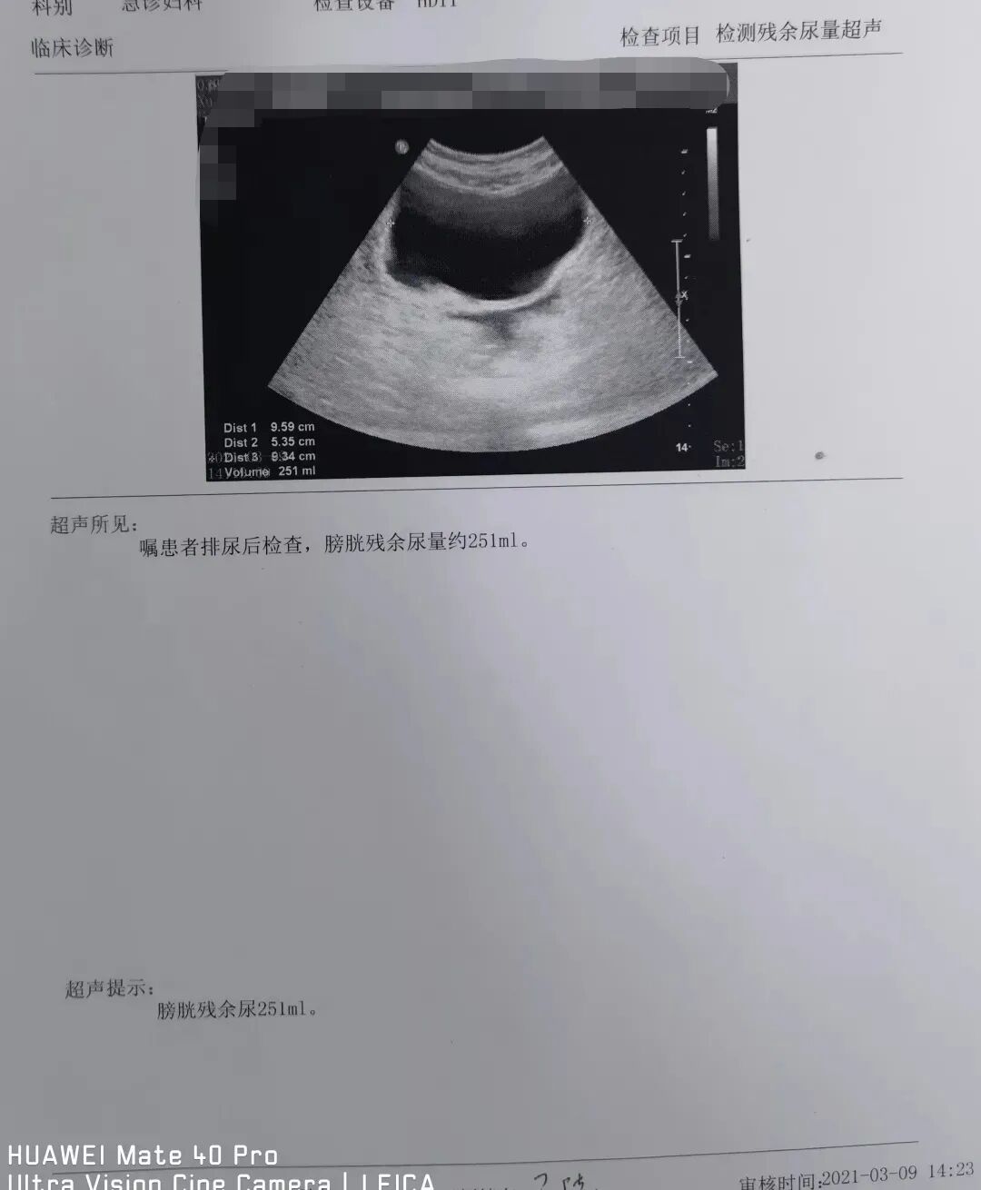 宫颈癌术后尿潴留案例分析