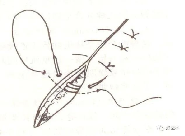 分离结扎钳怎么用【学生频道】外科手术基本功速成法，书上学不到的秘诀！（聂邯洛医师推荐）_https://www.jmylbn.com_新闻资讯_第38张