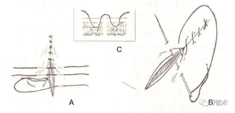 分离结扎钳怎么用【学生频道】外科手术基本功速成法，书上学不到的秘诀！（聂邯洛医师推荐）_https://www.jmylbn.com_新闻资讯_第44张