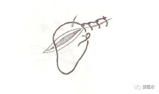 分离结扎钳怎么用【学生频道】外科手术基本功速成法，书上学不到的秘诀！（聂邯洛医师推荐）_https://www.jmylbn.com_新闻资讯_第47张