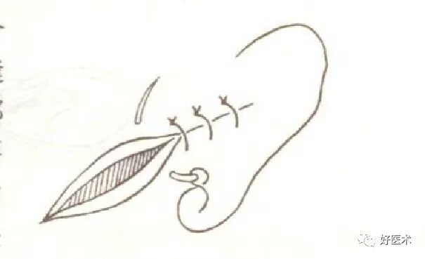 分离结扎钳怎么用【学生频道】外科手术基本功速成法，书上学不到的秘诀！（聂邯洛医师推荐）_https://www.jmylbn.com_新闻资讯_第36张