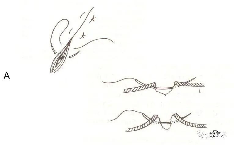 分离结扎钳怎么用【学生频道】外科手术基本功速成法，书上学不到的秘诀！（聂邯洛医师推荐）_https://www.jmylbn.com_新闻资讯_第37张