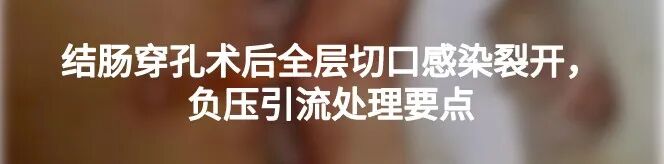 宫剪怎么样收藏！产科经典手术“子宫下段剖宫产术”步骤，图文详解！_https://www.jmylbn.com_新闻资讯_第21张