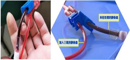 三氧疗法怎么代理止痛好帮手！“三氧大自血疗法”让血液更年轻_https://www.jmylbn.com_新闻资讯_第5张