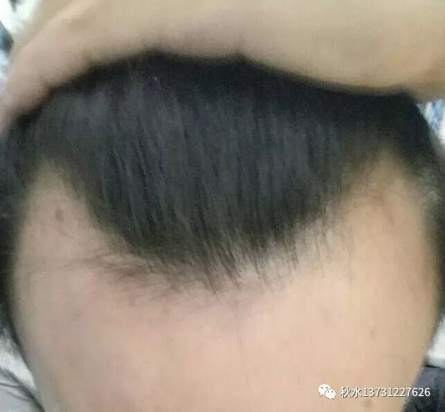 秋水：发际线不规则面相看性格命运