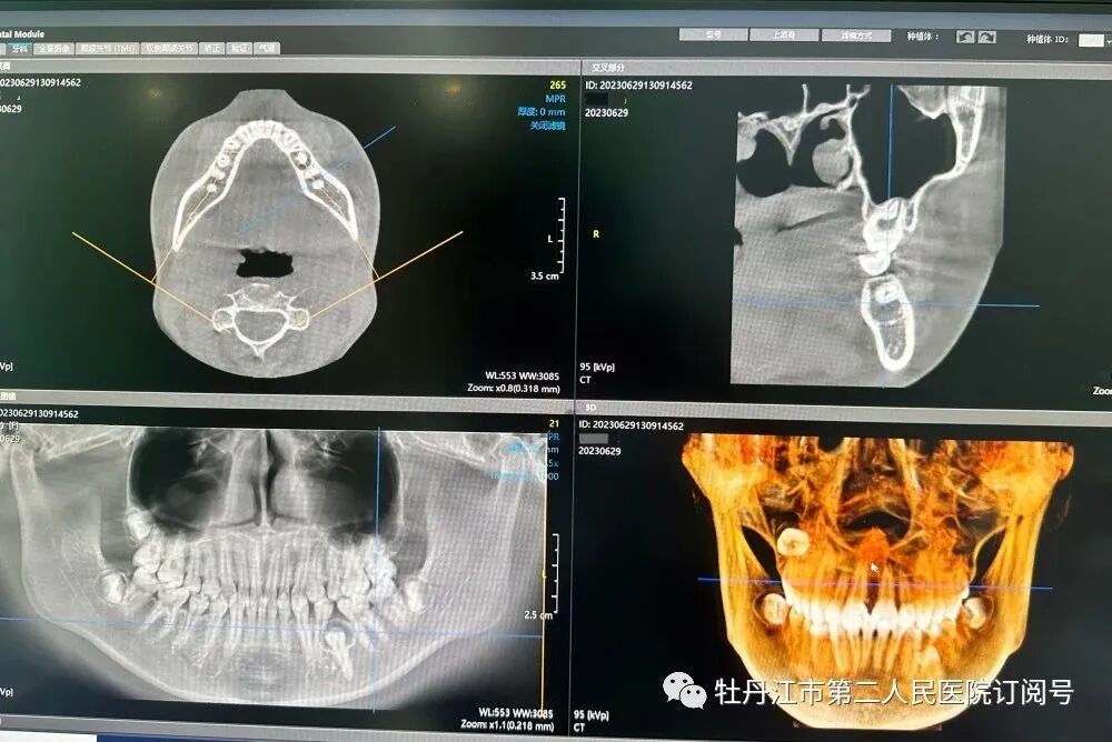 牙科全景机怎么复位【二院·设备】“超快高清”的口腔全景CT来喽！——牡丹江市第二人民医院引进最新德国KaVo 3D eXam CBCT正式投入使用_https://www.jmylbn.com_新闻资讯_第14张