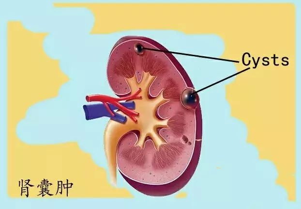 經皮腎囊腫穿刺抽液固化術經典案例展示