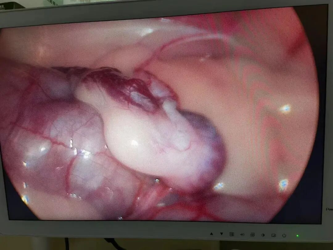 术后忧郁？不存在的！