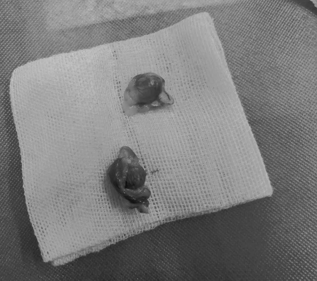 术后忧郁？不存在的！