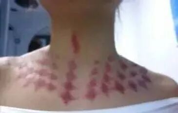 厚刮痧板怎么用刮痧的几种好手法，效果好到惊人_https://www.jmylbn.com_新闻资讯_第9张