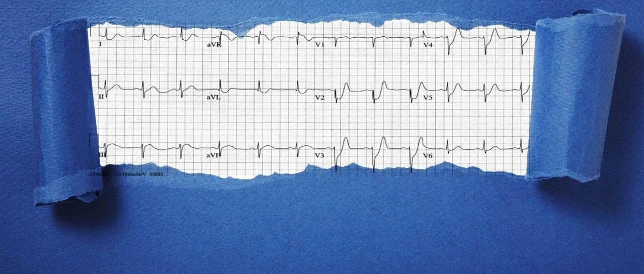 de winter——被撕裂的T波｜识“图”寻踪