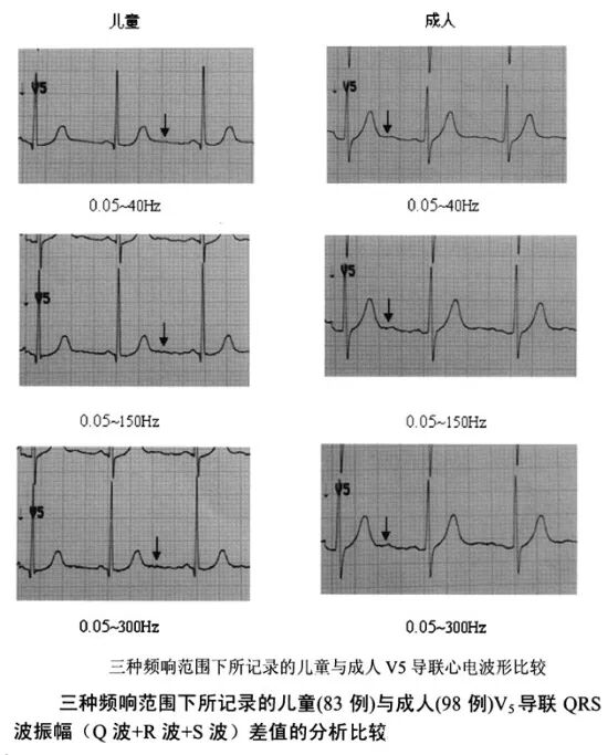 心电图纸怎么看心电图记录纸上的小秘密｜临床解惑_https://www.jmylbn.com_新闻资讯_第4张