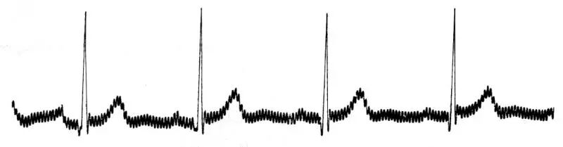 心电图纸怎么看心电图记录纸上的小秘密｜临床解惑_https://www.jmylbn.com_新闻资讯_第6张