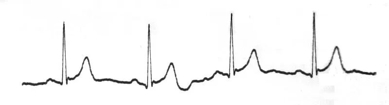 心电图纸怎么看心电图记录纸上的小秘密｜临床解惑_https://www.jmylbn.com_新闻资讯_第5张