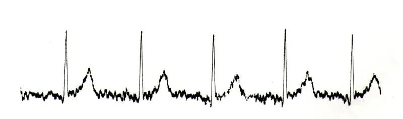 心电图纸怎么看心电图记录纸上的小秘密｜临床解惑_https://www.jmylbn.com_新闻资讯_第7张