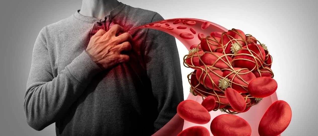 施仲伟教授：短期双抗后长期阿司匹林单药治疗成为PCI术后高出血风险患者治疗新选择｜TCT2020