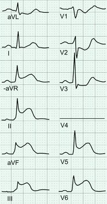 心电图怎么切换导联换个姿势来看心电图，打开一个全新的视角_https://www.jmylbn.com_新闻资讯_第9张