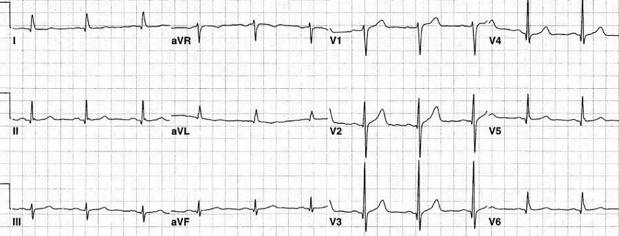 心电图怎么切换导联换个姿势来看心电图，打开一个全新的视角_https://www.jmylbn.com_新闻资讯_第5张