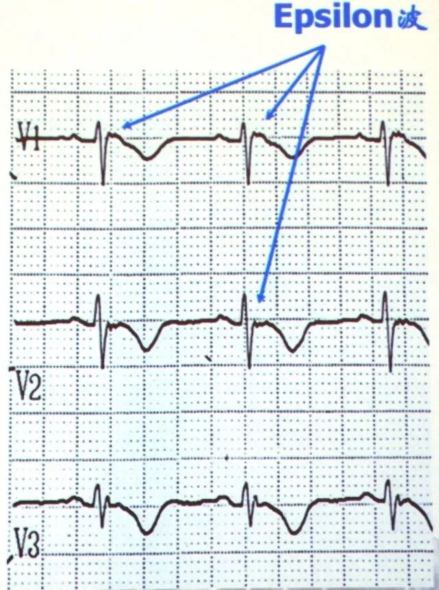 图18  epsilon波-转载自网络