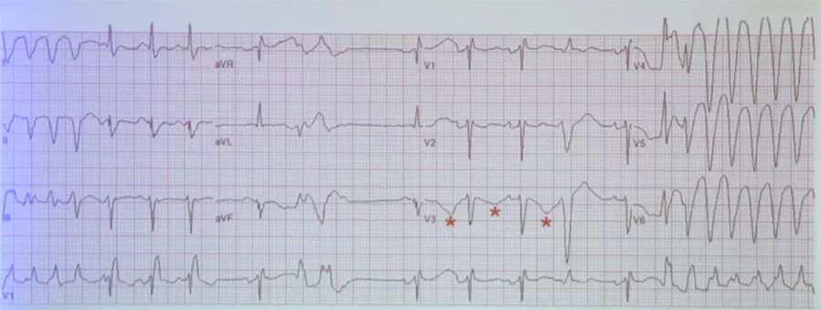 多变的T波，如何鉴别及危险分层？