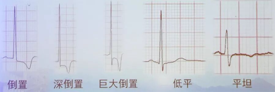 多变的T波，如何鉴别及危险分层？