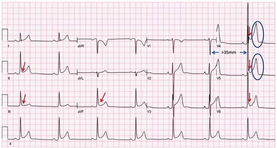 多变的T波，如何鉴别及危险分层？