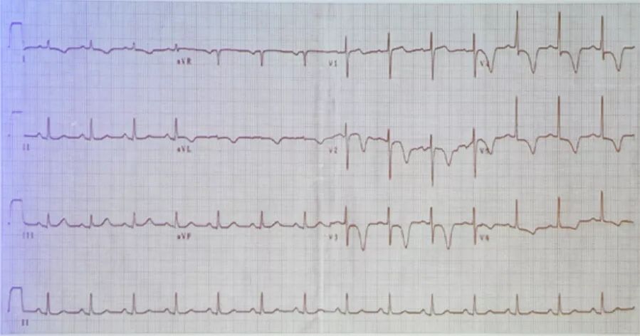 多变的T波，如何鉴别及危险分层？