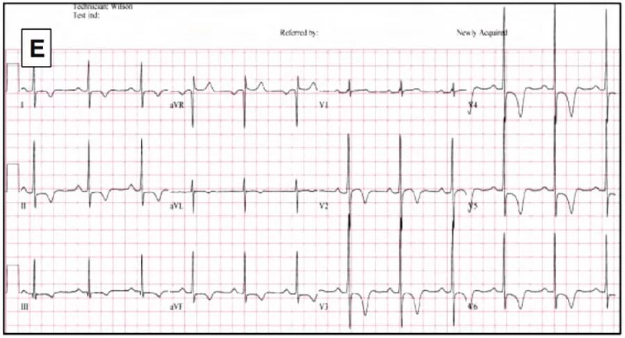 多变的T波，如何鉴别及危险分层？