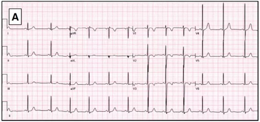 多变的T波，如何鉴别及危险分层？