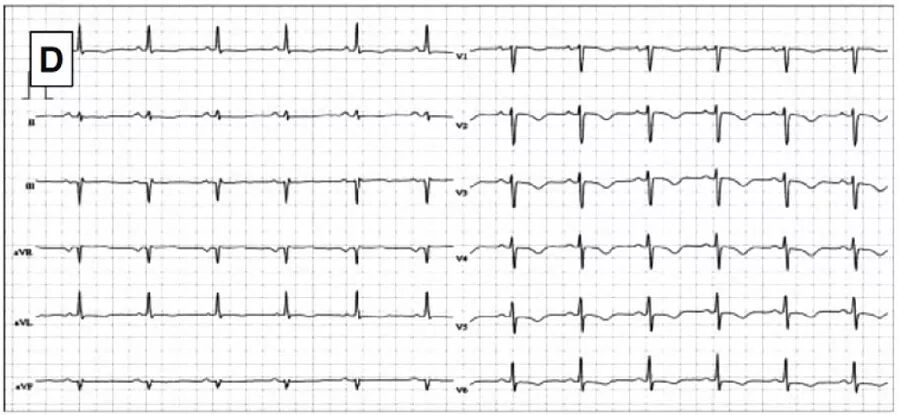 多变的T波，如何鉴别及危险分层？