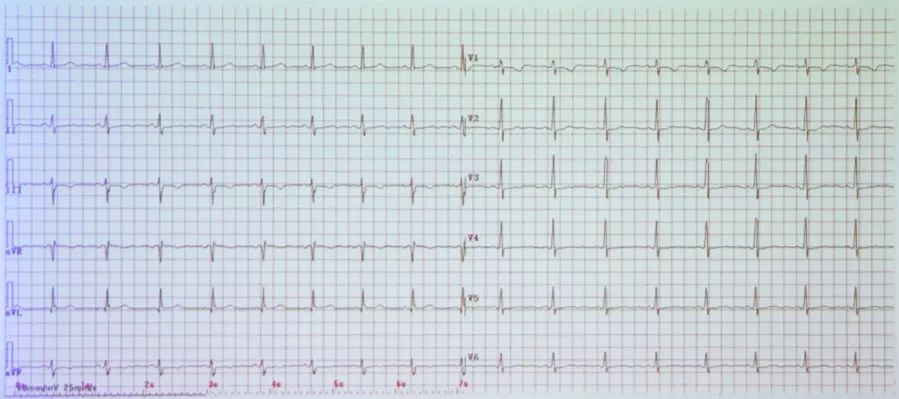 多变的T波，如何鉴别及危险分层？