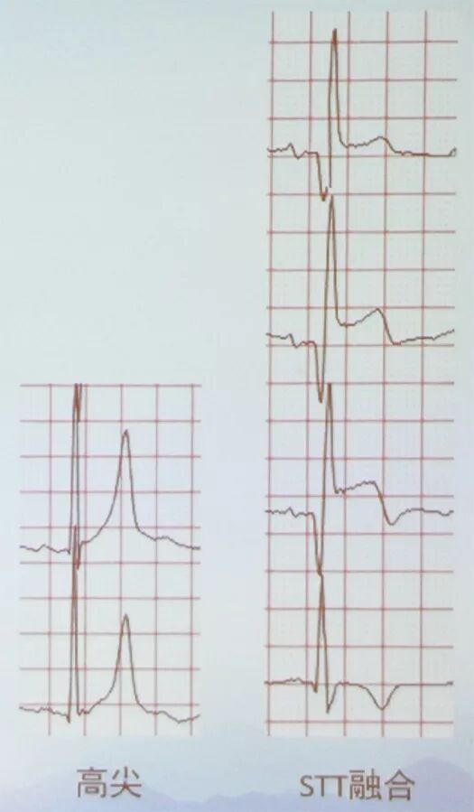 多变的T波，如何鉴别及危险分层？