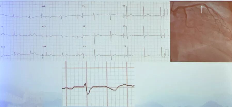 多变的T波，如何鉴别及危险分层？