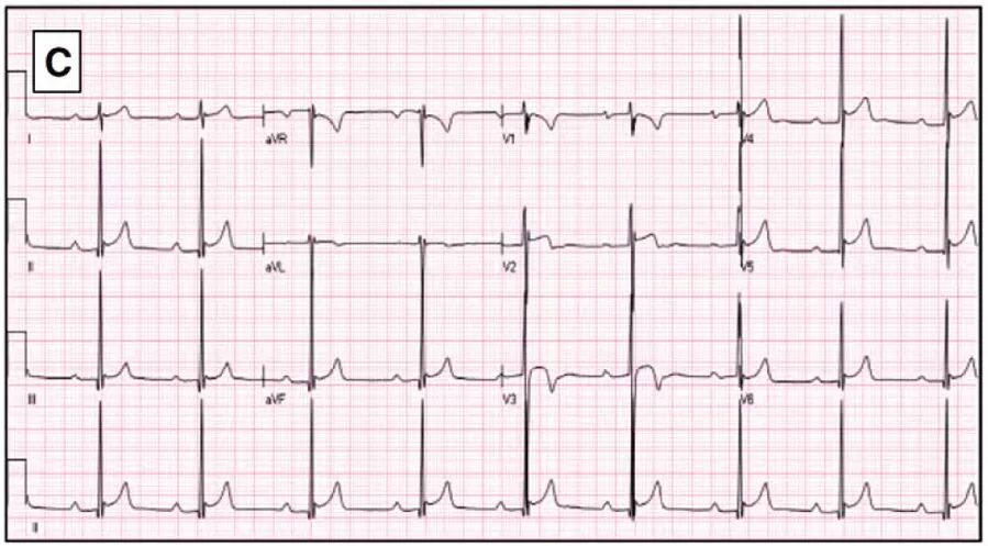 多变的T波，如何鉴别及危险分层？