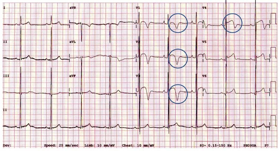 多变的T波，如何鉴别及危险分层？