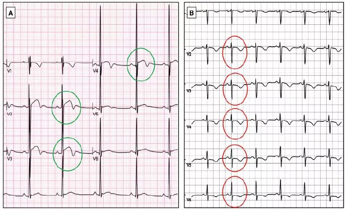 多变的T波，如何鉴别及危险分层？