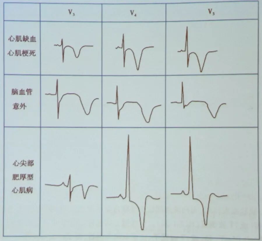 多变的T波，如何鉴别及危险分层？