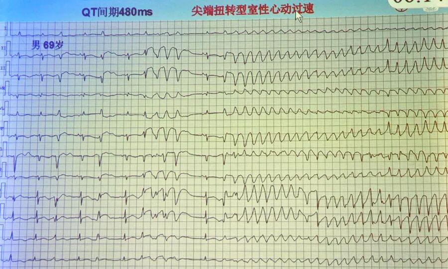 牢记心电图危急值,临床需警惕!-友友