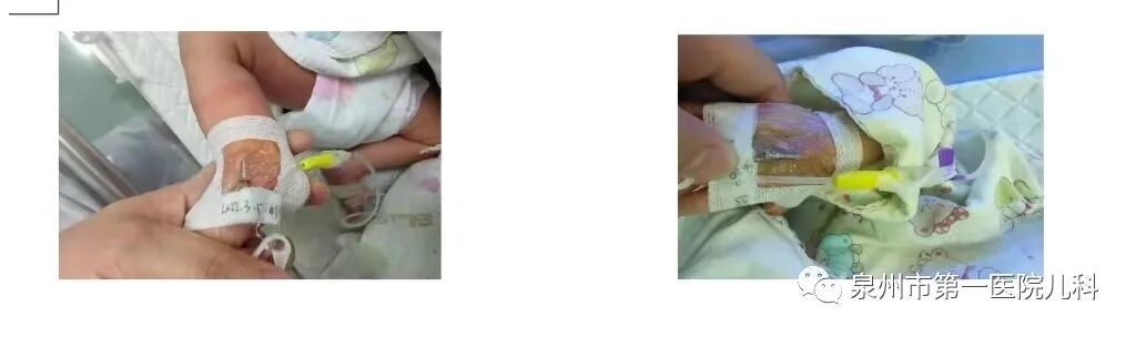 留置针绷带怎么缠小儿静脉留置针的7个固定小妙招，儿科护士都学起来！_https://www.jmylbn.com_新闻资讯_第4张