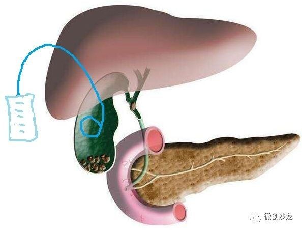 引流管怎么冲管居家护理：引流管看护和简单冲管_https://www.jmylbn.com_新闻资讯_第2张