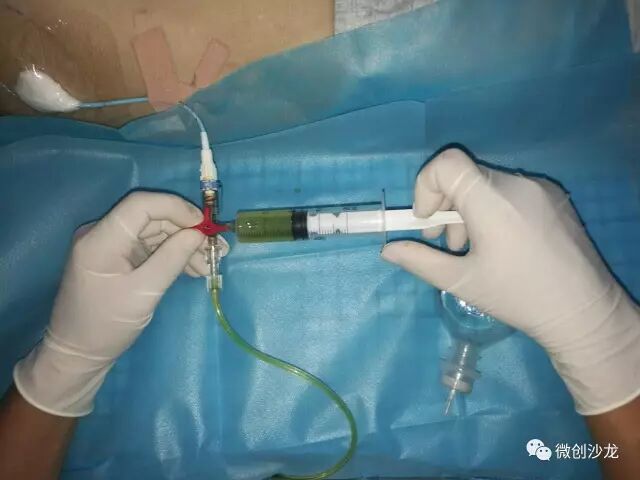 引流管怎么冲管居家护理：引流管看护和简单冲管_https://www.jmylbn.com_新闻资讯_第16张