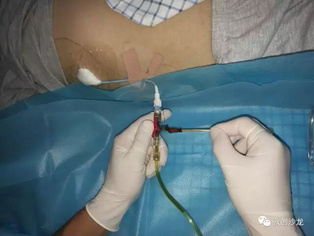 引流管怎么冲管居家护理：引流管看护和简单冲管_https://www.jmylbn.com_新闻资讯_第11张