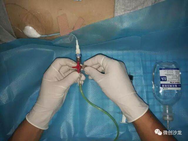 引流管怎么冲管居家护理：引流管看护和简单冲管_https://www.jmylbn.com_新闻资讯_第17张